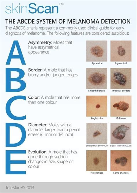 ABCDEFG of melanoma DermNet