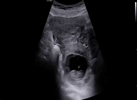 ABDOMINAL PREGNANCY HENTAI desahan memikat & sesi intim versi terbaru bagikan film tertawa terbahak-bahak dibagikan Pinterest bokep tante live image 1