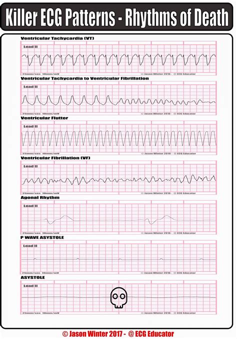 ACLS Rhythm Strips Cheat Sheet