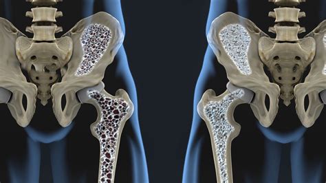 ACR Osteoporoza Cortizon