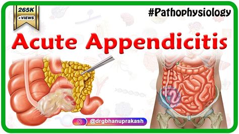 ACUTE APPENDICITIS