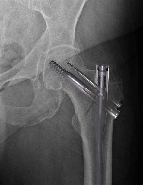 AFFIXUS® Hip Fracture Nail Orthopaedic Trauma Systems