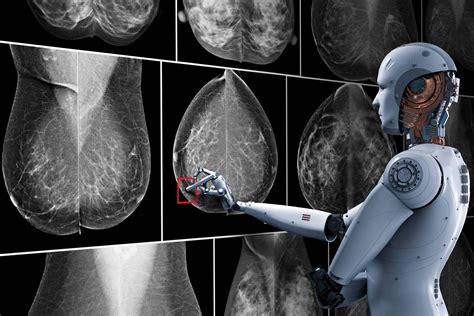 AI improves breast cancer detection rate by 20 percent