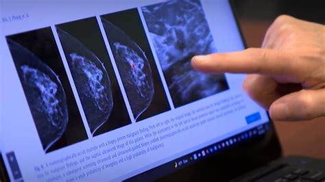 AI-supported mammogram screening increases breast cancer detection by 20%, study finds