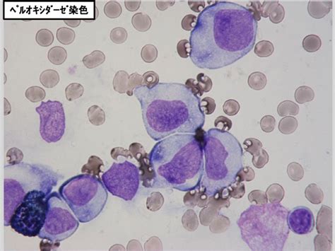 AML with t(9;11)(p21.3;q23.3);KMT2A-MLLT3(MLL-AF9)