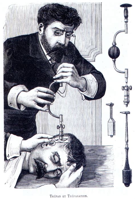 An illustrated history of trepanation | ScienceBlogs - wintechmobiles.com