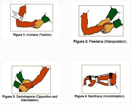 Ancient Fracture Treatment methods by Susrutha - wintechmobiles.com
