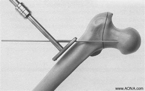 AONA Dynamic Hip & Condular Screw Technique Guide