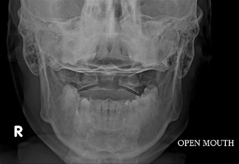 AP Cervical Spine X-Ray with Open mouth