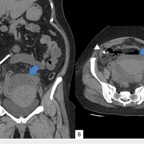 appendicitis perforasi adalah - elchoricharrua.com
