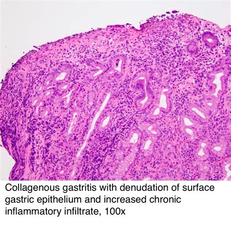 ASGE How Best to Treat Collagenous Gastritis?