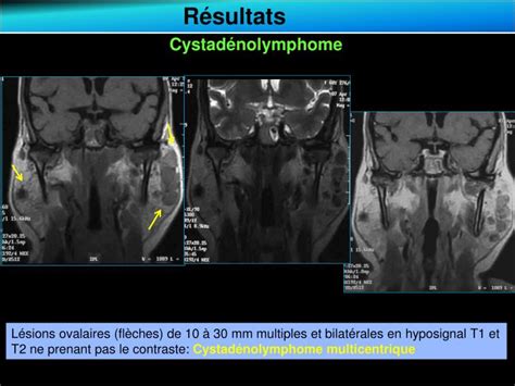 ASPECT IRM DU CYSTADENOLYMPHOME DE LA PAROTIDE