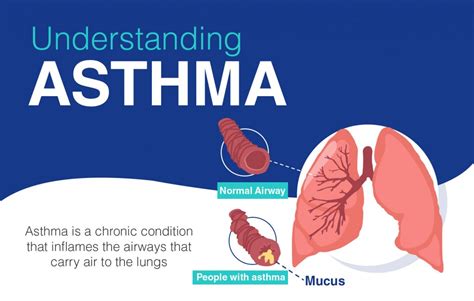 ASTHMA 1