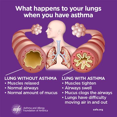 ASTHMA 1