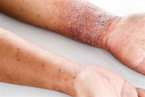 ATOPIC DERMATITIS