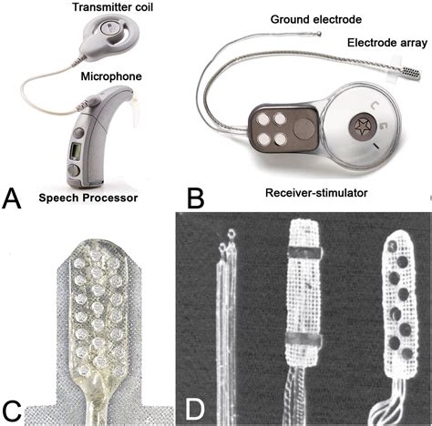 AUDITORY BRAINSTEM IMPLANTATION AS AN OPTION TO IMPROVE HEARING …