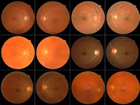 AUTOMATED DIAGNOSIS OF DIABETIC RETINOPATHY USING FUNDUS IMAGES pdf