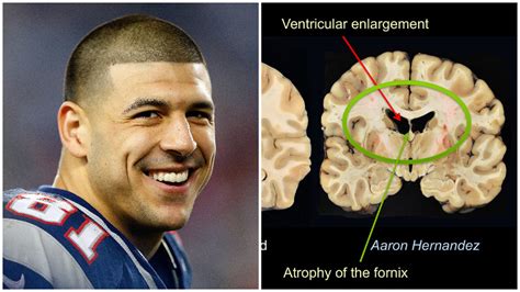 Aaron hernandez brain.  Noch Aaron Hernandez suffered from a brain disease linked...