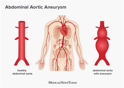 Abdominal Aortic Aneurysm Patient