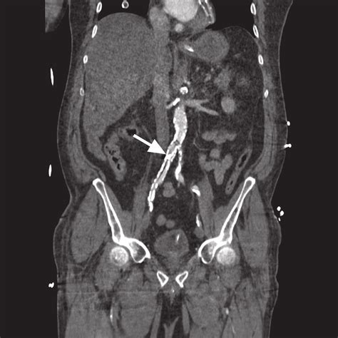 Abdominal Aortic Calcification Erectile Dysfunction - IDEPEM …