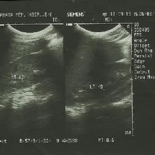 Abdominal Sonogram Showing Poor Corticomedullary …