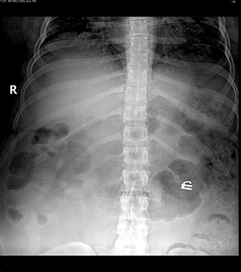 Abdominal X-rays: KUB vs. Supine AP view : r/Radiology - Reddit