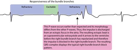 Aberrant ventricular conduction (aberrancy, aberration) - ECG …