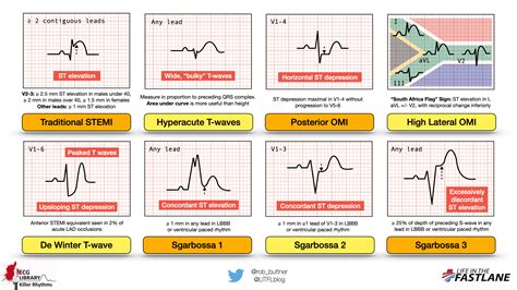 Abnormal ECG Patterns
