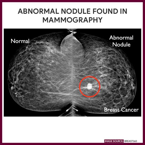 Abnormal Mammogram 40