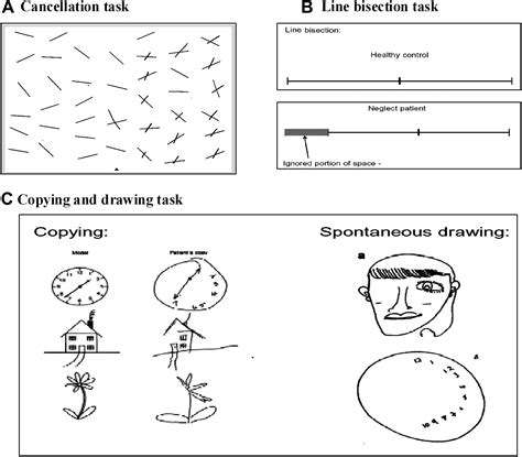 Abnormal visual dynamics in spatial neglect pdf