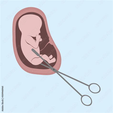 Abortion illustration