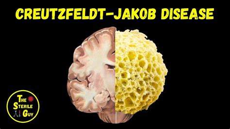 About CJD and Prion Disease - Creutzfeldt-Jakob Disease Foundation