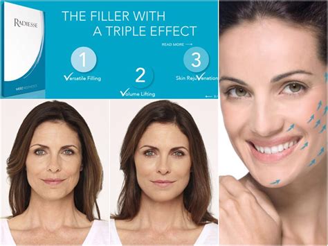 About Radiesse - Radiesse Injectables