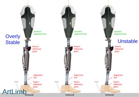 Above-knee prosthetic alignment