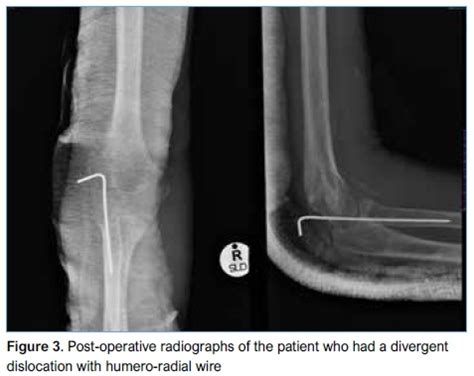 Abrasion left elbow icd 10. 500 results found. Showing 1-25: ICD-10-CM Diagnosis Code S80.212A [convert to ICD-9-CM] Abrasion, left knee, initial encounter. Left knee abrasion; Left knee abrasion with infection. ICD-10-CM Diagnosis Code S80.211A [convert to ICD-9-CM] Abrasion, right knee, initial encounter. Right knee abrasion; Right knee abrasion with infection. 