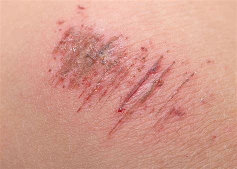 Abrasive skin. An abrasion is a scrape on your skin. This is a break in your skin that happens when your skin rubs off. It may bleed slightly and hurt. An abrasion often happens when something hits or drags against your skin (friction). Abrasions are usually accidental injuries. They only affect the outermost layers of your skin. See more 