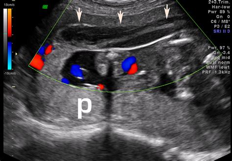 Abruption - Cancer Therapy Advisor