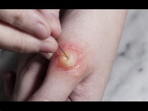 Abscess videos popping. Dr. Pimple Popper has posted a few other abscess videos, and this one is a massive pocket filled with liquid. "I was wondering the other day if humans got abscesses. 