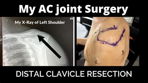 Ac Joint Clavicle Excision - Shoulder - Surgery - Physio.co.uk