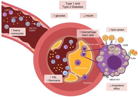 Accelerated Atherosclerosis in Diabetes