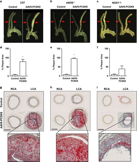 Accelerated atherosclerosis development in C57Bl6 mice by