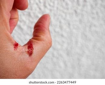 Accident hand pic. .  ...