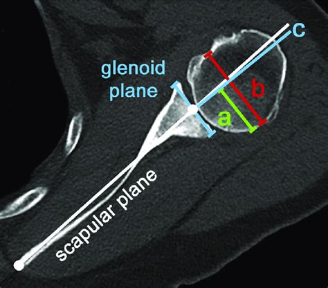 Accuracy of the glenohumeral subluxation index in ... - PubMed