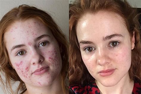 Accutane endicia. Accutane's side effects were nasty, but for me, the results were worth it. Imagine walking into your kitchen to find that your stove is on fire. Imagine throwing on buckets of water, spraying an ... 
