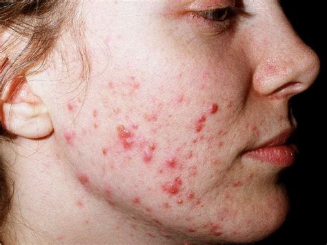 Achne - Lifestyle and habits. Several causative and aggravating factors of shoulder acne include: Diet: Studies show a relationship between high-glycemic foods and the development of acne. Hygiene: Allowing sweat and oil to accumulate on skin and rewearing clothing can clog pores and increase surface bacteria.