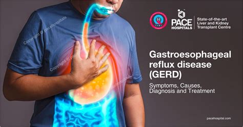 Acid Reflux and GERD Causes Treatment and Symptoms