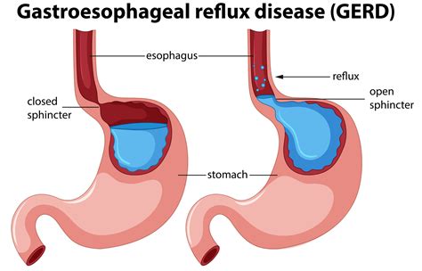 Acid Reflux pos-op : r/noburp