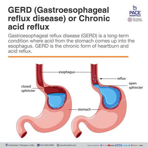 Acid reflux.  GERD is a very common problem in the United States.