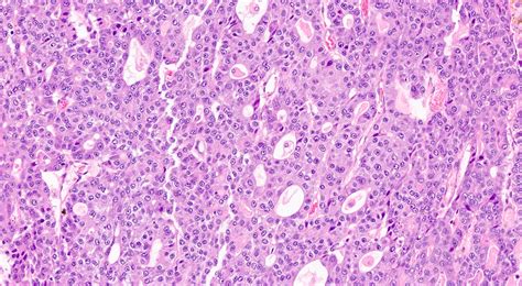 Acinar Cell Carcinoma