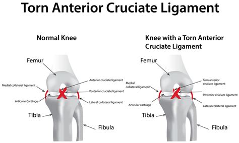 Acl Surgery Details